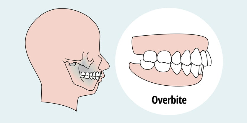 A graphic of what an overbite looks like.