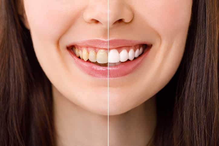 A woman's smile before and after teeth whitening. 