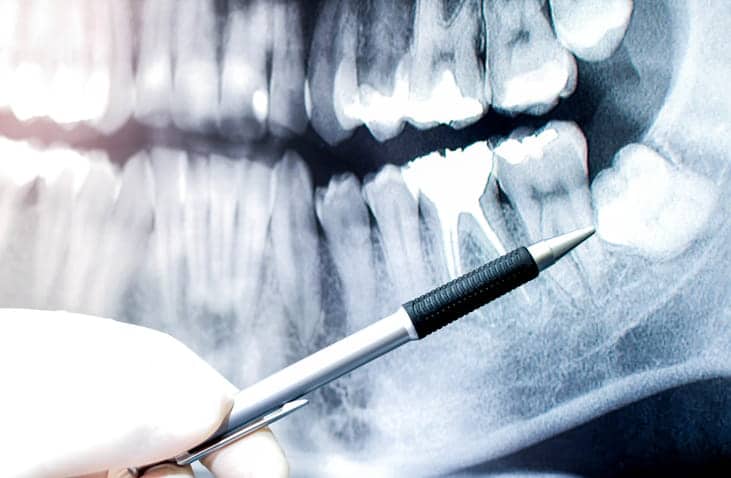 An X-ray showing an impacted wisdom tooth.