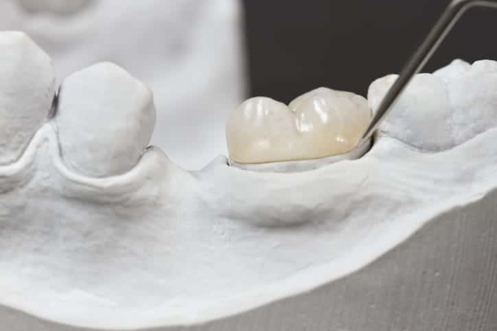 A closeup of a dental onlay on a molar tooth shown on a plaster model.
