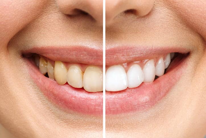 Photo of a woman's mouth to show cosmetic dentistry before and after.