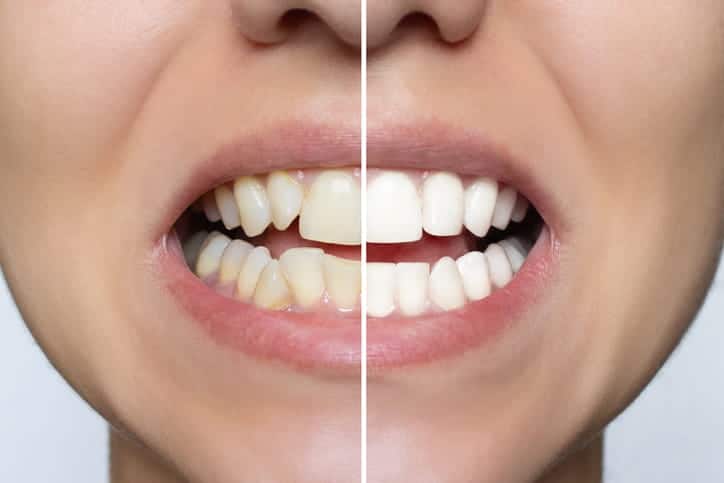Photo of a woman's mouth to show cosmetic dentistry before and after.