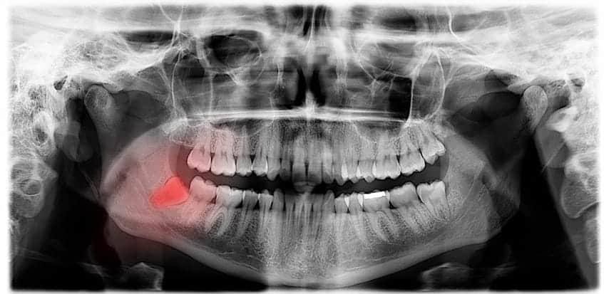 An X-ray of a mouth with the impacted wisdom tooth highlighted in red.
