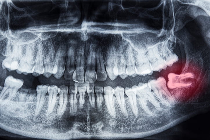 An X-ray showing an impacted wisdom tooth.