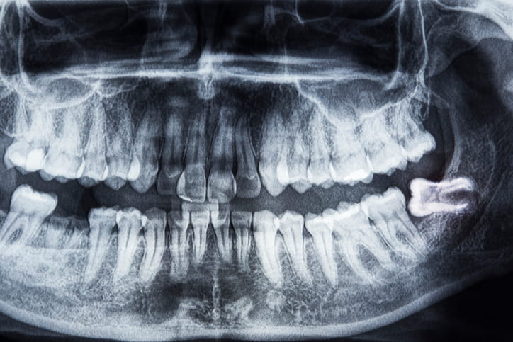 An x-ray showing impacted wisdom teeth.