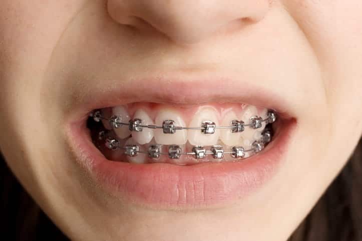 Focus is on a person showing their metal braces.