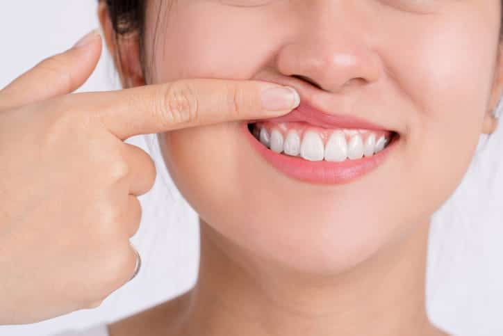 A woman smiling as she lifts her lip to show her gums.