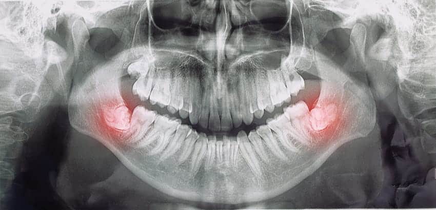An x-ray showing impacted wisdom teeth.