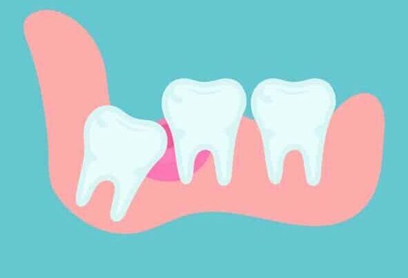 Impacted wisdom tooth