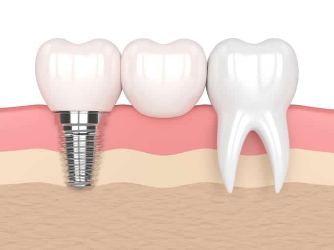 A 3D rendering of an implant with a dental cantilever bridge.
