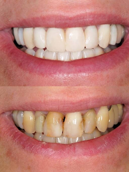 A before and after shot of a person's smile after they received veneers.