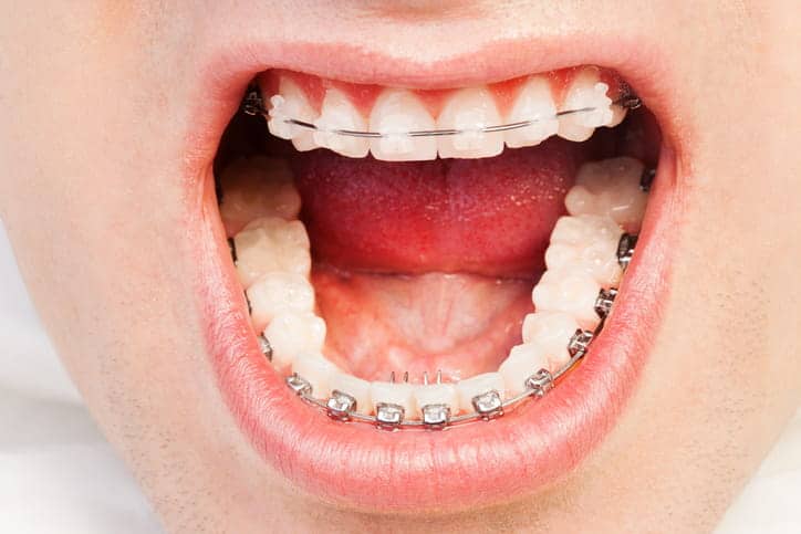 A person with their mouth open showing off their self-litigating braces.