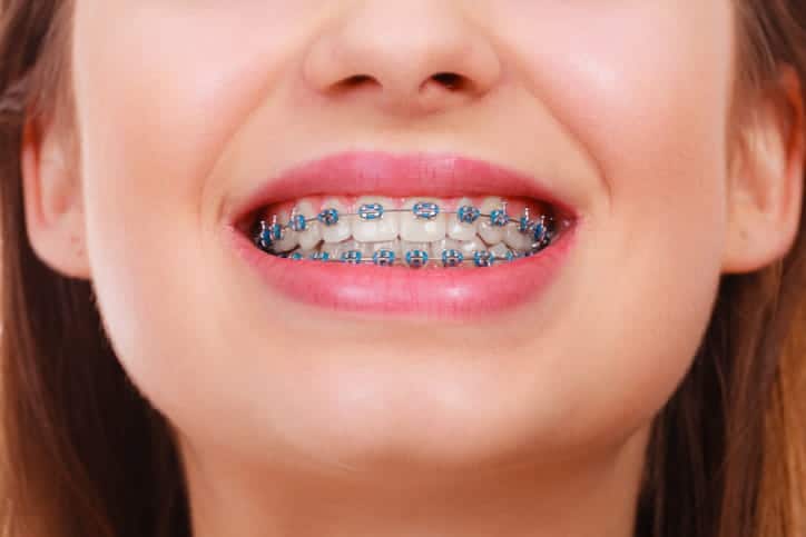 A woman smiling with metal braces.
