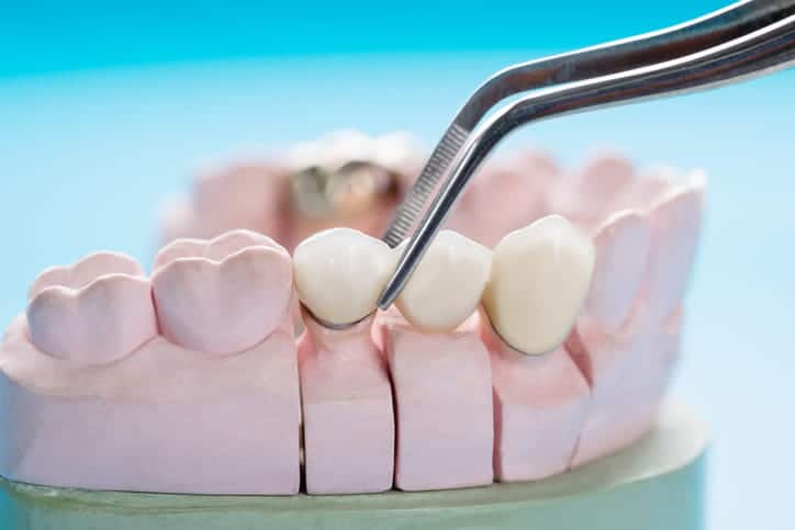 A model of a mouth as a dentist places a bridge on it.