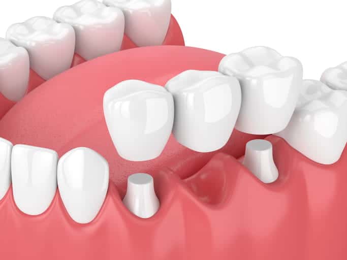 A 3D rendering of a jaw with a dental bridge.