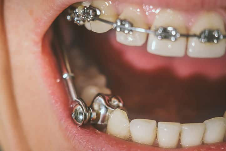 Dental appliance and braces.
