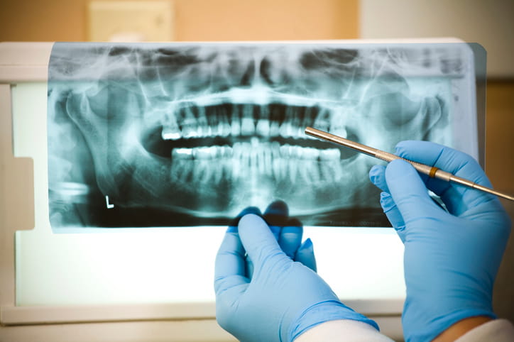 A dentist examining a dental x-ray to spot infection.
