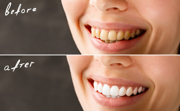 A before and after photo regarding teeth whitening services.