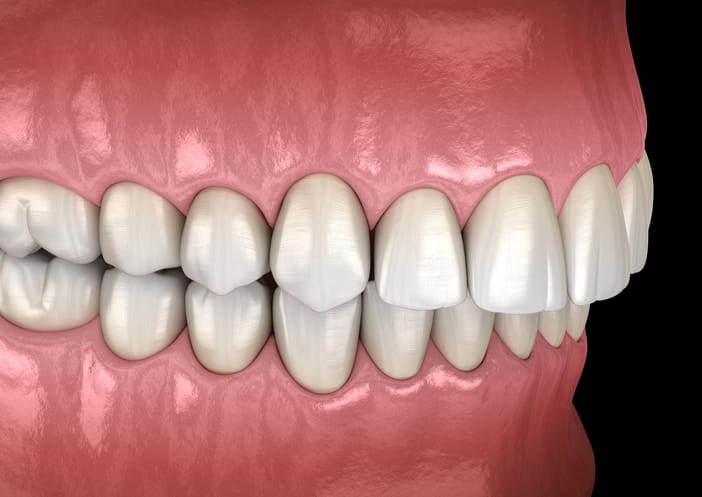 A 3D graphic showing what an overbite looks like.