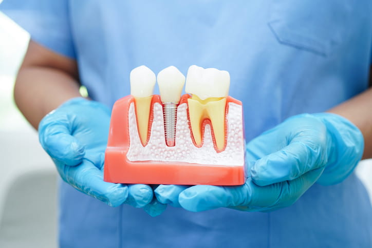 A dentist holding a model that shows what a dental implant looks like.