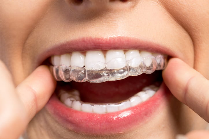 A woman putting in a clear retainer on her top teeth.