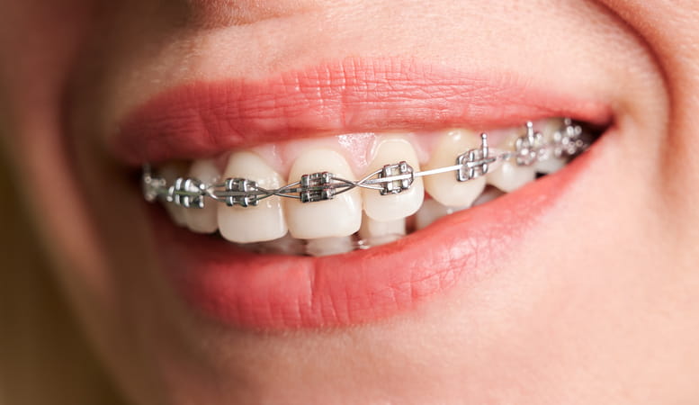 A woman smiling with self-ligating braces on.
