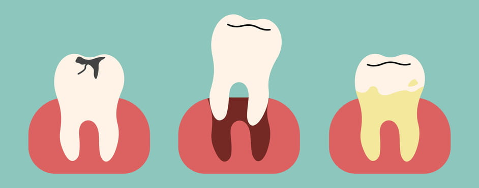 A graphic showing three damaged teeth, with the middle one being dislodged from the socket.