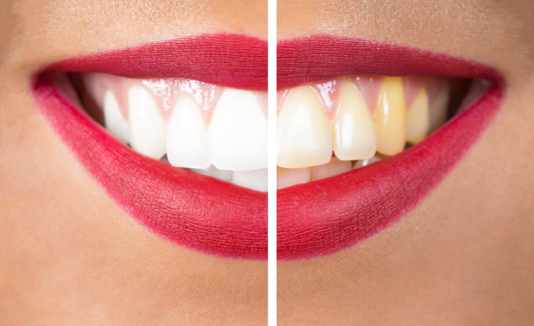 Before and after image of a woman getting her teeth whitened during a smile makeover. 
