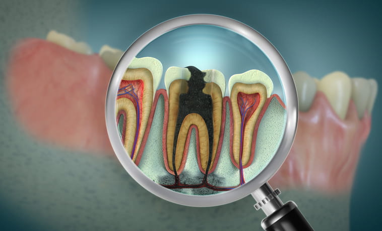 A graphic of a tooth cavity that is in need of a root canal. 