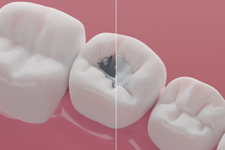 Both types of fillings shown in a tooth graphic. 