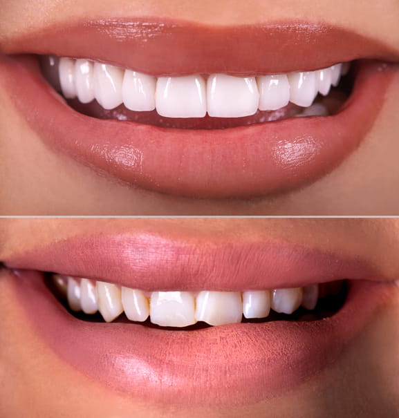 A before and after shot of a cosmetic smile makeover.