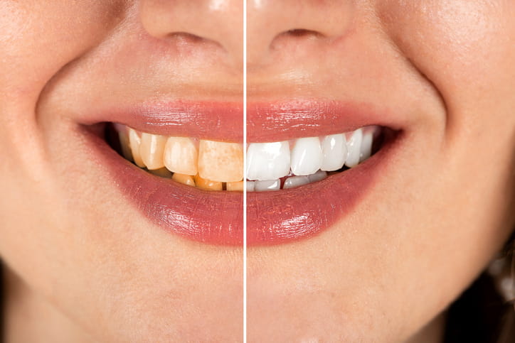 A before and after shot of a cosmetic smile makeover.