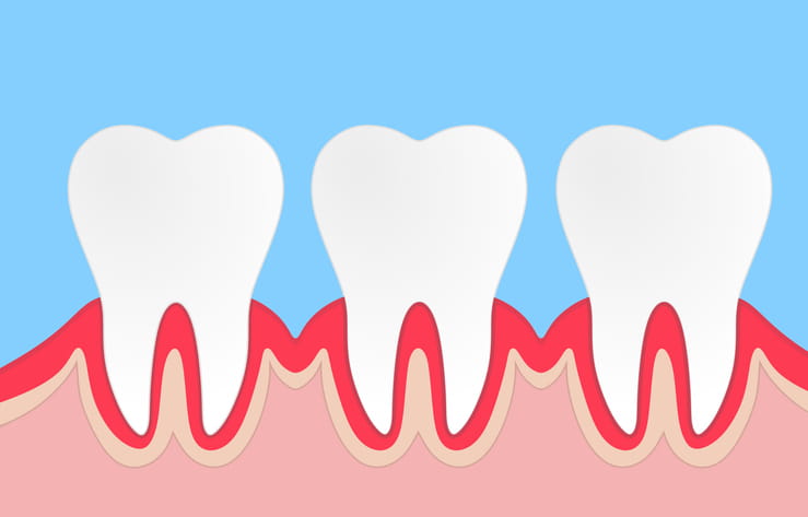 A graphic showing red, swollen gums around three teeth. 