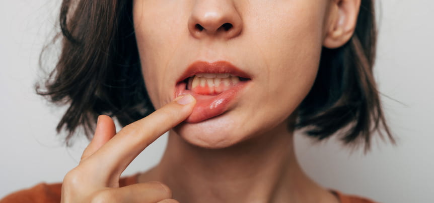 A woman pulling on her lower lip to show her swollen gums. 