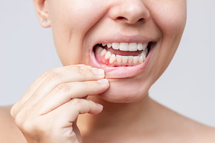 A woman pulling at her lower lip to show her swollen gums. 