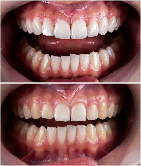 Before and after photos of dental bonding on a patient's teeth. 