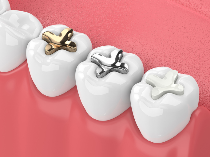 Tooth Fillings In Reno Old 2 3d render of teeth with inlay