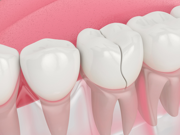 What To Do If You Have A Chipped Or Broken Crown 1 3d render of jaw with cracked tooth