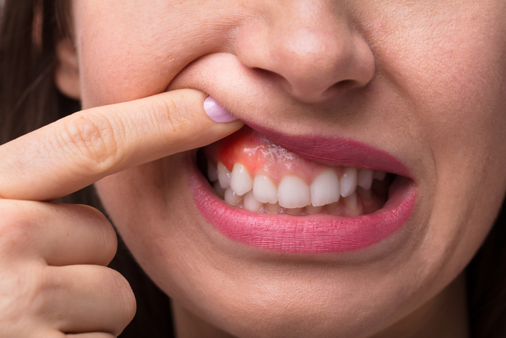 Woman showing swelling of her gum