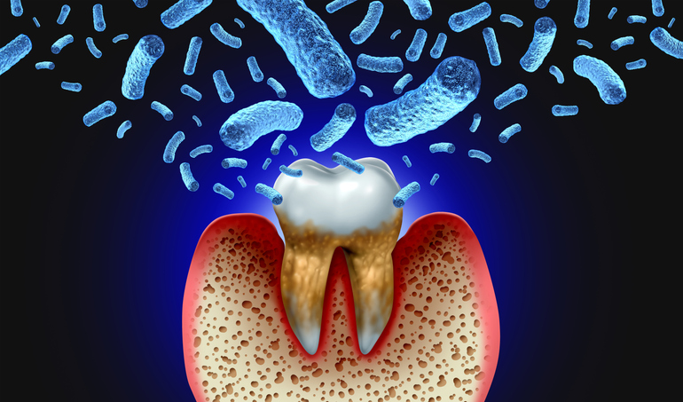 Bacterial tooth infection