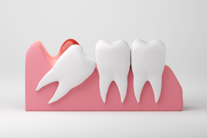 Understanding Wisdom Teeth Removal 1 Wisdom tooth infection