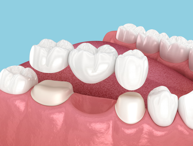 Dental bridge based on 2 teeth