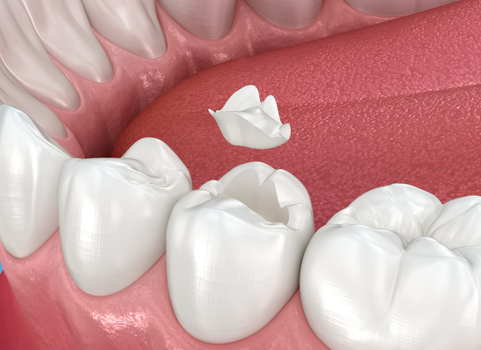 Inlay ceramic crown placement. Medically accurate 3D animation