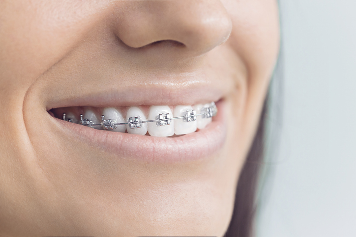 Henderson Braces And Orthodontics 1 Woman with brackets