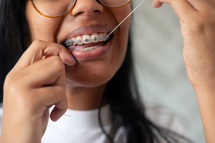 A woman flossing between her brace wire.