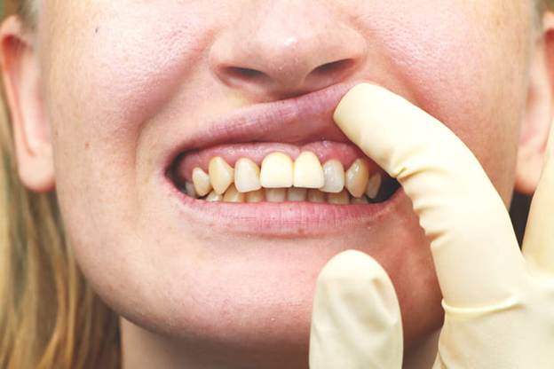 A dentist inspects a patient's smile to see if there is any dental plaque.