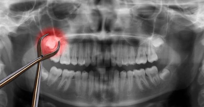 A dental X-ray showing an impacted wisdom tooth highlighted in red.